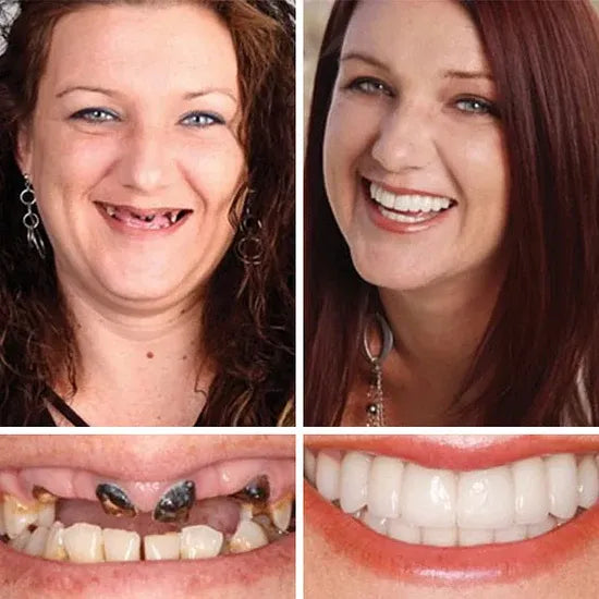 "🎁Ends Today: 70% OFF! ⏰Yagoo™ Medical Full Denture with Strong Suctiond🦷Obtain American Dental Association (ADA) Certification