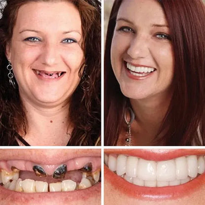"🎁Ends Today: 70% OFF! ⏰Yagoo™ Medical Full Denture with Strong Suctiond🦷Obtain American Dental Association (ADA) Certification