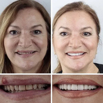 "🎁Ends Today: 70% OFF! ⏰Yagoo™ Medical Full Denture with Strong Suctiond🦷Obtain American Dental Association (ADA) Certification
